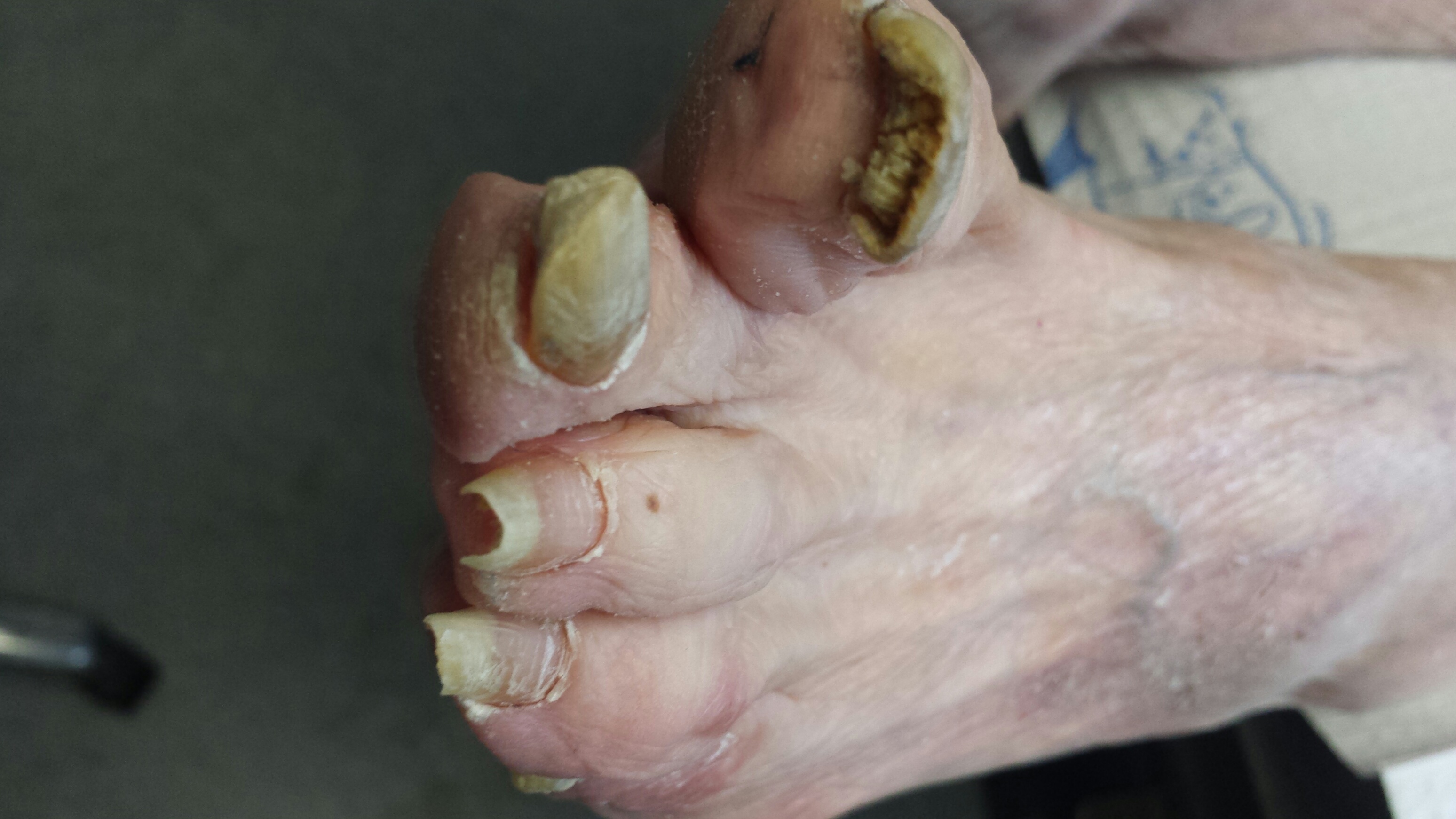 toes diseases